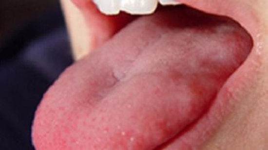 سرطان الفم مرض خبيث يبدأ بقروح على الوجه والرقبة
