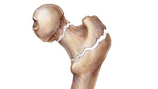 5 أسباب لتشوهات العظام بعد العمليات الجراحية