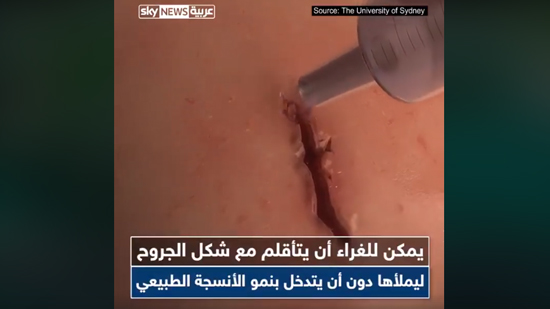 بالفيديو.. غراء طبي يغلق الجروح في 60 ثانية فقط