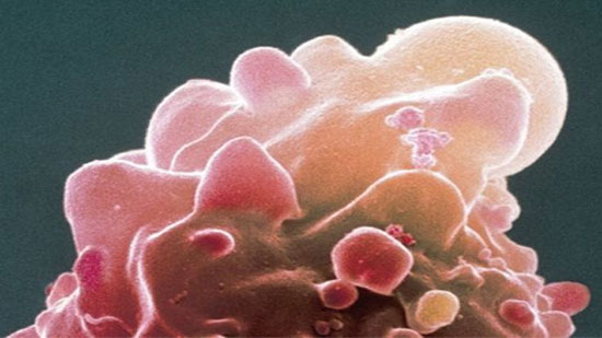 فحص سرطان الأمعاء «يكشف مشاكل صحية أخرى»