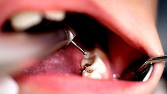 هناك علاقةٌ مدهشةٌ بين صحة الأسنان وصحة أعضاء الجسم
