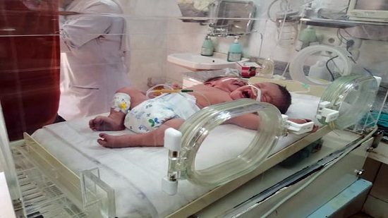 نادرة طبية .. طفل مولود برأسين ملتصقين بمستشفى أسيوط الجامعي
