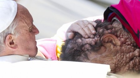 بالصور البابا فرنسيس يسحر قلوب العالم بتقبيله رأس رجل مريض بمرض جلدي خطير
