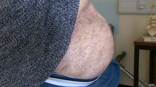  جراحة غير مسبوقة في بريطانيا تنقذ ذراع مريض سرطان