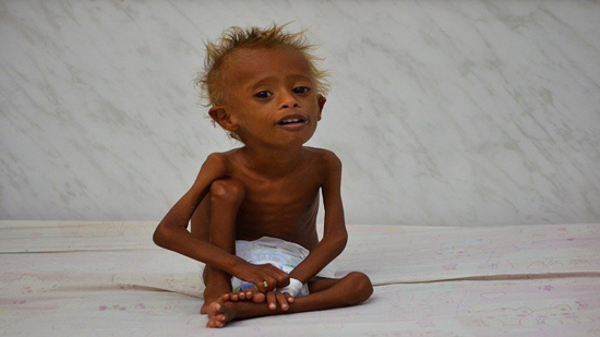 صورة لطفل يمني في مستشفى