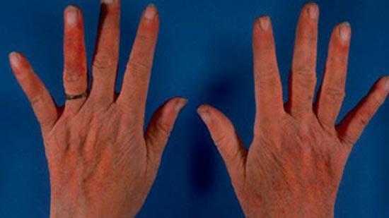 الصابون يسبب لبعض السيدات حساسية اليدين
