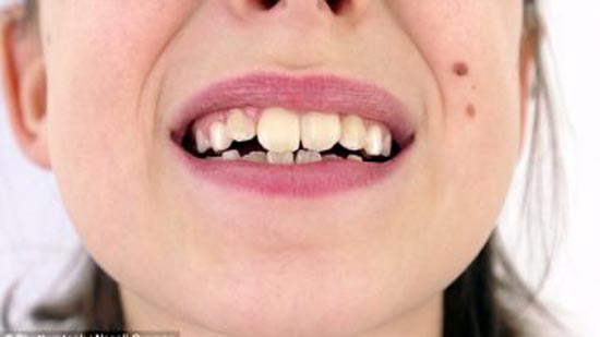 حساسية الأسنان نتيجة فرط التنظيف