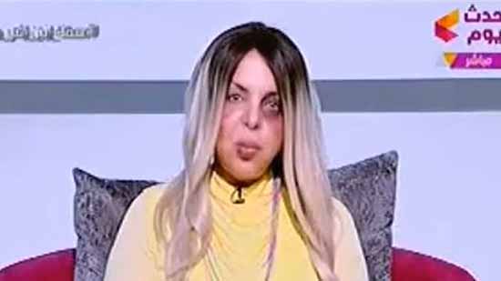 مذيعة قناة «الحدث» تظهر بآثار ضرب واعتداء جسدي على وجهها (فيديو)