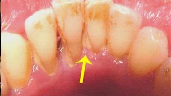 خليط طبيعي يقضي على مشكلة التهابات وبكتيريا الأسنان