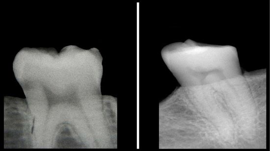 الكشف عن نقص فيتامين هام من حالة الأسنان