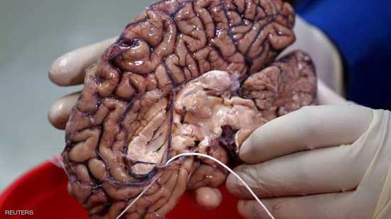 دماغ بشري في بنك الدماغ في مدينة نيويورك