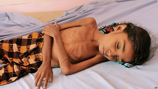 أسرة يمنية: إما أن ندفع الإيجار أو نوفر حليب الأطفال