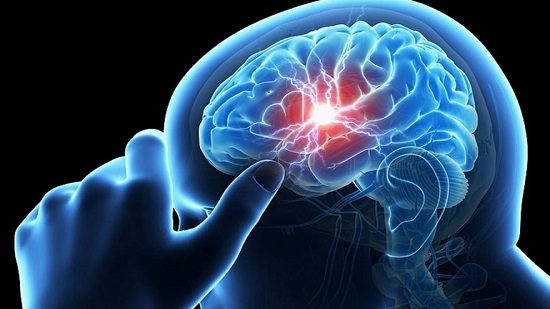 دراسة حديثة : السكتة الدماغية تهدد ربع سكان العالم 
