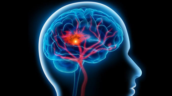 العَيش عند الطرق المزدحمة يرفع خطر الإصابة بالسكتة الدماغية بنسبة 30%
