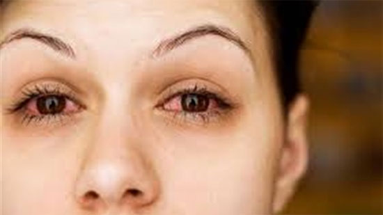احمرار العين تنذر بالتهاب فيروسى خطير