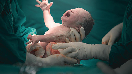في مثل هذا اليوم.. الجراح الأمريكي جيسي بينيت يجري أول عملية ولادة قيصرية في أميركا بنجاح