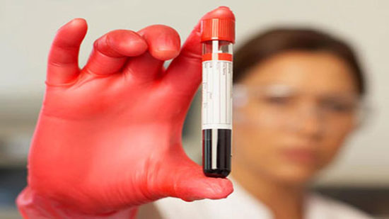 اختبار دم جديد يمكن أن يتنبأ بظهور السل قبل 6 أشهر من الإصابة
