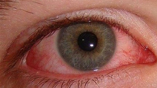 ما علاقة احمرار العين بفيروس كورونا؟
