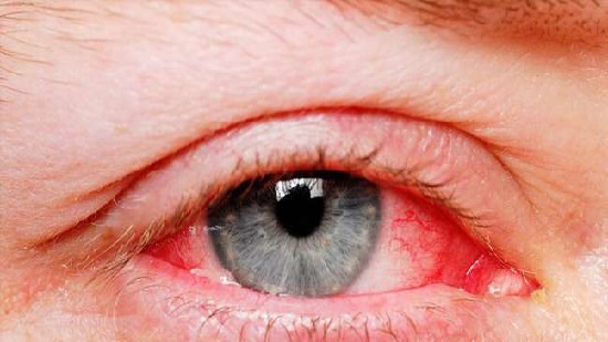 طبيب عيون: كورونا يدخل الجسم عن طريق العين وينتشر عبر الدموع