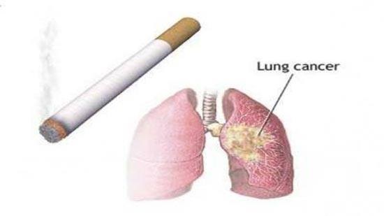 أكتشاف الأدلة العلمية التي تؤكد العلاقة بين التدخين والإصابة بسرطان الرئة
